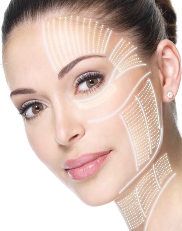 Ультразвуковой SMAS-лифтинг